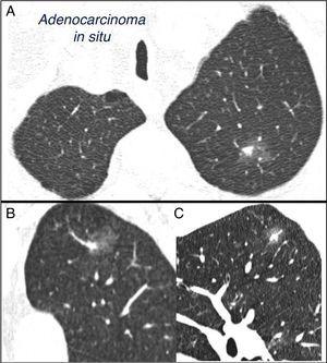 mieszany, subsolidowy, samotny guzek płucny w lewym górnym płacie. Tomografia komputerowa klatki piersiowej z odcinkami o grubości 2 mm u pacjenta z pojedynczym guzkiem płucnym w lewym górnym płacie. Plaster osiowy (a) w płatach górnych oraz rekonstrukcje koronowe (B) i strzałkowe (C) w lewym górnym płacie. 18-mm naziemno-szklany pojedynczy guzek płucny, z 7-mm stałym elementem we wnętrzu. Resekcja za pomocą torakoskopii wspomaganej wideo ujawniła gruczolakoraka.