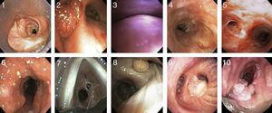 Images of different types of non-malignant obstructive airway disease. (1) Post-intubation stenosis. (2) Granulation stenosis secondary to silicone stent. (3) Tracheobronchomalacia. (4) Stenosis secondary to Wegener's granulomatosis. (5) Stenosis secondary to tuberculosis. (6) Tracheobronchopathia osteochondroplastica. (7) Idiopathic stenosis. (8) Hamartoma. (9) Solitary papilloma. (10) Papillomatois.