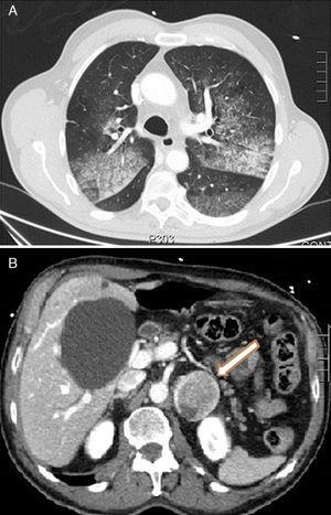 (A) CT axial image showing crazy-paving lung pattern: ground-glass consolidations and interlobular septal thickening. (B) CT axial image with contrast medium showing heterogeneous left adrenal lesion, 46mm×40mm.