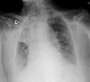 Right upper lobe atelectasis with mediastinal shift toward the affected side.