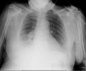 Absence of right upper lobe atelectasis after non-invasive ventilation. Infiltration can be seen in the right lower lobe.