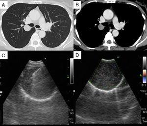 Chest CT revealed a round, well-defined 2.4-cm nodule in S2, adjacent to the right upper lobe bronchus (A, B). EBUS showed a well-defined hypoechoic tumor, with an echogenic capsule and posterior acoustic enhancement (C, D).