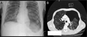 (A) Hyperlucency of left lower lung. (B) Extensive pneumothorax.
