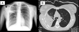 (A) Posteroanterior chest X-ray showing alveolar condensation and loss of volume in right upper lobe. (B) Chest computed tomography showing parenchymal consolidation and ground-glass opacities in right segment 3 and part of apical and anterior segments with air bronchogram and a fully patent bronchus.