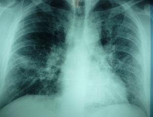 Chest X-ray of the patient at hospital admission showing alveolar infiltrates, diffuse and expanded throughout the whole left lung and the right middle lung field.