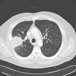 Chest CT image of right upper lobe.