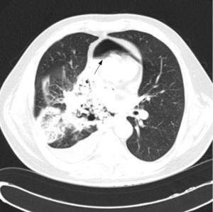 Chest computed tomography showing large tumor in the right lung with direct mediastinal invasion and pneumomediastinum (arrow) anterior to the heart.