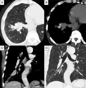 High-resolution CT of the chest showing mucus plugging of dilated bronchi (A, lung window) and high-attenuation lesions (B, mediastinal window) in the right lower lobe. Coronal view CT with intravenous contrast revealed partially high-attenuation mucus plugs (C). Follow-up CT showed improvement of mucus plugging and presence of bronchiectasis (D).