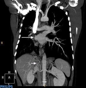 The CT scan shows absence of right pulmonary veins draining into the left atrium, as well as the inferior phrenic artery with origin in the right renal artery.
