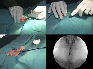 Fluoroscopy-guided percutaneous stent implantation.