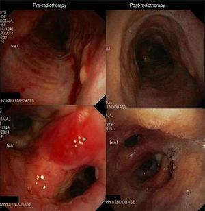 Bronchoscopic images of tracheal and bronchial wall involvement before and after EBR treatment.