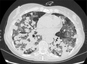 Chest computed tomography, axial slice. Parenchymal window.