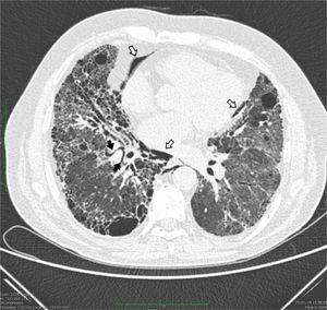 Pulmonary Interstitial Emphysema Following Spirometry in CPFE Syndrome ...