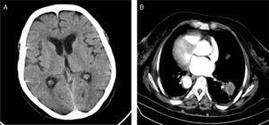 (A) Brain CT with no intracranial lesions; (B) chest CT showing a 3cm lobulated mass in the right lower lobe.
