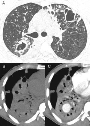 (A) Axial CT image obtained with the lung window setting at the level of bronchial bifurcation, showing multiple bilateral nodules and cavities in the lung parenchyma. CT images obtained with the mediastinal window setting at the level of the lower lobes before (B) and after (C) contrast administration reveal consolidation in the right lower lobe with a rounded enhancing lesion inside the consolidated area (arrows).