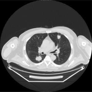 Chest computed tomography. Images of nodules in right lower lobe and left upper lobe.