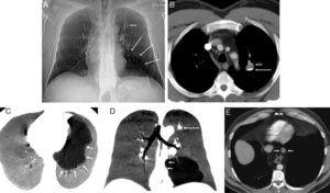 (A) Chest X-ray showing nodular lesions in left upper lobe (LUL) (short arrow) and basal radiopacity with reduced blood perfusion (long arrows). (B) Axial computed tomography (CT) image of chest, confirming the presence of a cystic-type lesion in the left upper lobe, with typical fluid–fluid level. The supernatant (short arrow) has a density similar to water, while the density of the fluid in the lower part (long arrow) is calcific (calcium milk). (C) MinIP (minimum intensity axial projection) CT image showing a well-defined multicystic lesion (arrows), suggestive of malformation, in the left lower lobe basal segments, not communicating with the airway. (D) MiniIP coronal reconstruction showing a mild mass effect on the mediastinum towards the right side (short arrows). Note the nodular lesion in the LUL (long arrow). (E) Axial CT image showing a cystic lesion in the posterior mediastinum, adjacent to the anterior thoracic esophageal margin (arrows).