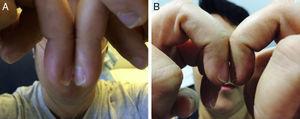 A: Schamroth sign. B: Resolution of the Shamroth sign after one month of corticosteroid treatment.