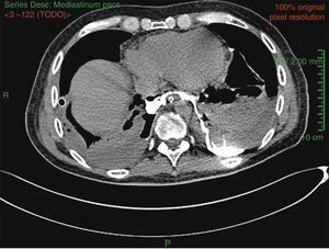 Chest tomography showing bilateral pleural effusion with signs of pneumomediastinum. A fistula communicates the esophagus with the posterior mediastinal compartment, with accumulation of contrast in the lower slope of both hemithoraces.