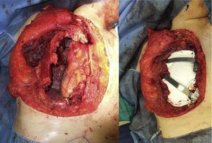 Large chest wall defect after resection. Reconstruction with 2 pectus bars and PTFE mesh.