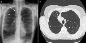 Long-standing interlobar air cavity (short arrow) and right upper lobe atelectasis (long arrow) after implantation of endobronchial valves: (a) chest radiography and (b) chest CT scan.