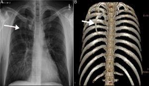 (A) Frontal chest radiograph: showing a right-sided vertically oriented linear density with the same opacity as a bone extending from the center of the chest inferomedially. (B) 3D volume rendering technique clearly shows the extra rib originating from the proximal rib inferomedially.