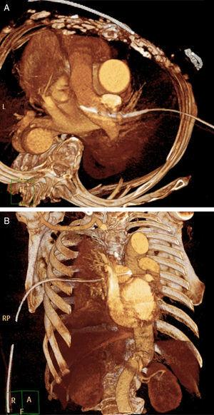 CT scan reconstruction showing the chest tube inside the main pulmonary artery through the right pulmonary artery. (A) Axial. (B) Coronal.