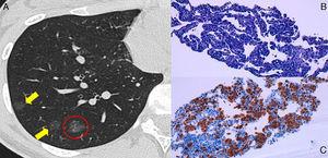 Computed tomography image (A) showing multiple nonsolid nodules (arrows) in the right lung. The nonsolid nodule that was biopsied is indicated within the red circle. Microscopic images (250×) of the lung biopsy (B and C), showing interstitial infiltration by the cancer cells on hematoxylin–eosin staining (B). S100 protein positivity indicates melanocytic differentiation (C).