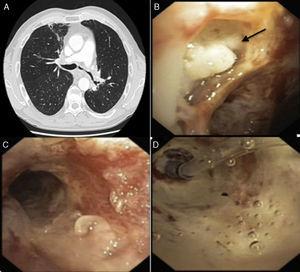 (A) Loss of volume in the left hemithorax with stenosis of the left main bronchus and bronchiectasis in the apical segment of the right upper lobe. (B) Left lower paratracheal ulcerative lesion covered with mucopurulent secretion (arrow). (C) Pseudomembranous mucosa in the distal third of the trachea and left main bronchus. (D) Balloon catheter dilation of stenosis in left main bronchus.
