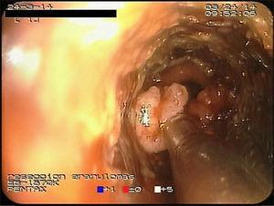 Microdebrider tip resecting a granuloma in the distal end of the metal prosthesis.