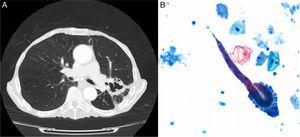 (A) Chest computed axial tomography: consolidation in the posterior segment of the left upper lobe with areas of cavitation with irregular walls. (B) Bronchial aspirate cytology (Papanicolaou stain) showing Strongyloides stercoralis filariform larvae.
