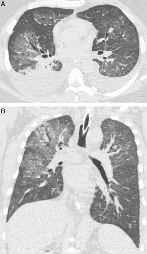A 28-year-old man with fever and rapidly progressive dyspnea. High-resolution computed tomography with axial (A) and coronal (B) reconstructions shows bilateral ground-glass opacities. Note also bilateral pleural effusion.