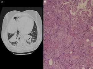 (A) Thorax with contrast scan: Bibasilar alveolar consolidations, more prominent in the right lung. (B) Lung biopsy: multiple intra-alveolar fibrin “balls” and inflammatory thickening of alveolar septa along with areas of organizing pneumonia with patchy distribution.