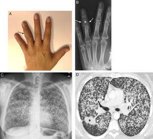 (A) Painful swelling (arrow) affecting the intermediate phalanx of the fourth finger of the left hand. (B) Radiograph of the left hand showing a lytic lesion in the intermediate phalanx of the fourth finger (asterisk) accompanied by increased volume of soft tissue (arrows). (C) Chest radiograph showing remarkable bilateral nodular involvement. (D) Axial CT image (lung window) showing a dominant spiculated mass in the right lung (asterisk), along with multiple bilateral small lung nodules.