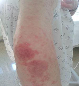 Severe psoriasis vulgaris on the patient's arm and forearm.