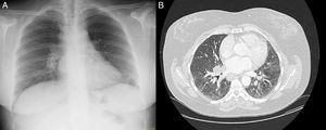 (A) Chest radiograph showing prominent right lung hilum with nodular morphology. (B) Chest CT showing bilateral hilar lymphadenopathies and ground glass infiltrates.