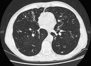 Bronchiectasie nel lobo medio e nella lingula associate a tappi di muco e nodi centrilobulari distali.