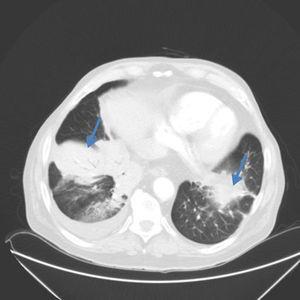 Lung computed tomography showing bilateral pulmonary infiltrates (right lung base and left lower lingula) with bronchoalveolar patter and right pleural effusion.