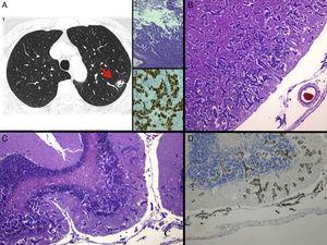 (A) 1: Chest computed tomography at diagnosis, showing a nodule in the left lower lobe suggestive of primary lung tumor; 2: histological image with hematoxylin–eosin (H&E) staining of the pulmonary nodule biopsy, consistent with adenocarcinoma (4×), and 3: immunohistochemistry staining positive for thyroid transcription factor 1 (TTF-1), confirming the primary pulmonary origin. (B) Histological image with H&E staining of MC with extensive deep invasion of the frontal cortex (2.5×) and (C) cerebellum (4×). (D) Staining positive for TTF-1, confirming infiltration by adenocarcinoma of pulmonary origin.