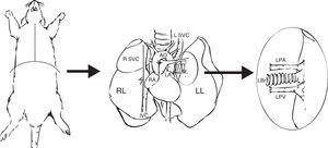 Extraction and preparation of the donor lung. Median sternotomy and dissection and extraction of the heart–lung block. Dissection of the left pulmonary artery (LPA), left pulmonary veins (LPV), and the left bronchus (LBr). AO: thoracic aorta; IVC: inferior vena cava; LA: left atrium; L SVC: left superior vena cava; LL: left left; RA: right atrium; R SVC: right superior vena cava.