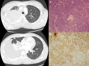 Computed tomography images showing the pulmonary lesion in the right upper lobe, and images from the pathological examination showing undifferentiated tumor cells (A) and positive immunoreaction to NUT antibody (B).