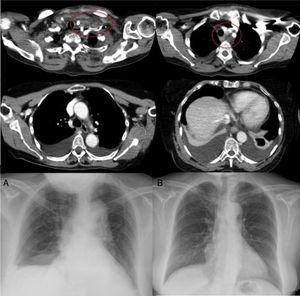 Axial computed tomography slices showing left laterocervical-supraclavicular collection, with diffuse extension throughout all mediastinal compartments (circled) and bilateral pleural effusion. (A) Posteroanterior radiograph of chest after removal of left pleural drainage tube, with the right pleural drainage tube still in place. (B) Posteroanterior radiograph of chest during follow-up, 3 months after the episode, showing complete resolution of bilateral pleural effusion.