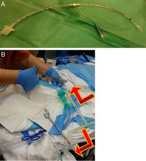 (A) Endotracheal tube, 3mm with balloon, extended by connecting it with another 3.5mm tube, through which the warm saline solution was instilled and collected after it was placed in the main bronchus. (B) Image showing the tube located in the trachea, used to ventilate the patient, and the tube placed in the main bronchus, used to instill the saline solution with an alternating clamping system (the outflow was clamped at the time of instillation and the inflow was clamped at the time of emptying the lung fluid), indicated by the arrows.