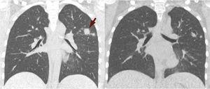 Initial CT scan (left image) showing ill-defined nodules (arrow) with upper lobe predominance. Follow-up CT scan (right image) performed 3 weeks after starting treatment showing cavitation of known nodules.