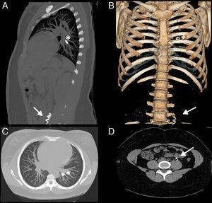 Chest-abdominal computed tomography: sagittal (A), coronal (B) and axial (C and D) slices. A metal spiral-shaped foreign body seen in the interior of the left ovarian vein (arrow) and rounded embolization material in a segmental pulmonary artery of the left lower lobe (asterisk).