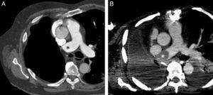 (A) Axial image of chest computed tomography, 6 months after pneumonectomy, showing thrombus on main pulmonary artery stump (asterisk) with no internal filling defects. (B) Axial image of chest computed tomography, 8 weeks after bronchopleural fistula repair, showing a new convex filling defect (asterisk) in the stump of the right main pulmonary artery.