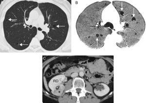 (A) Axial image of chest CT (pulmonary parenchymal window) showing multiple cysts in both lungs (arrows). Note the normal radiological appearance of the pulmonary parenchyma interposed between the cysts. (B) Minimum intensity projection (minIP) axial reconstruction of chest CT (pulmonary parenchymal window) showing multiple cysts in both lungs (arrows). (C) Axial CT image of the abdomen, showing a mass (black asterisk) in the right kidney (RD) with an area of fatty density (white asterisk), consistent with angiomyolipoma.