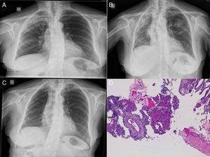 (A) Chest radiograph: infiltrate in right upper lobes. (B) Infiltrates in right upper lobe, right lower lobe and left upper lobe with loss of volume in the right hemithorax. (C) Favorable radiological progress. (D) Computed tomography-guided lung biopsy: inflammatory thickening of the septa with intra-alveolar fibrin balls.