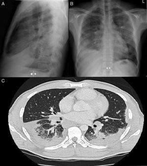 (A) PA chest radiograph. (B) Radiograph of lateral thorax, showing patchy alveolar infiltrates in the left middle and upper lobes. Predominantly right-sided bilateral pleural effusion. Hilar and mediastinal lymphadenopathy of pathological appearance. (C) Axial image of chest CT with intravenous contrast medium showing lymphadenopathy component in the mediastinal, bilateral hilar and periesophageal compartments. Bilateral alveolar involvement predominantly in the subpleural region of both bases, with accumulated nodal lesions and patchy air bronchogram in the subpleural region.