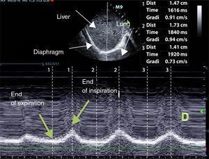 M-mode measurement of diaphragm excursion during a normal inspiration. The diaphragm can be seen as a hyperechogenic line indicated with an arrow. The excursion is measured as the difference between the end of the inspiration and the end of expiration (cm).